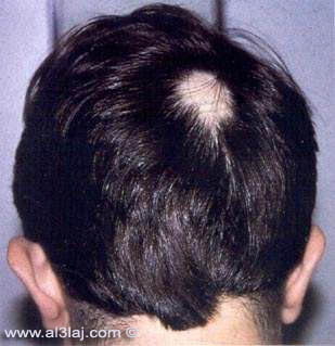 داء الثعلبة Alopecia areata