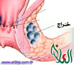 علاج الخراج أو الخراريج