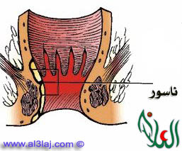 الناسور