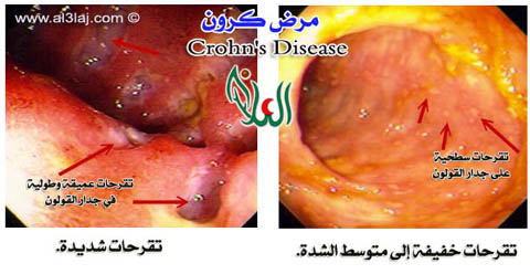 مرض كرون
