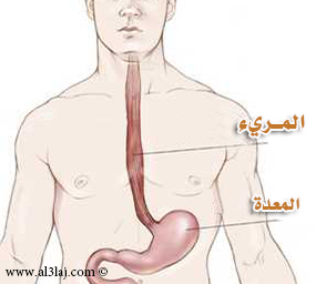 ارتداد المريء