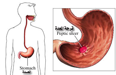 قرحة المعدة من السهل علاجها باستخدام العسل والأعشاب