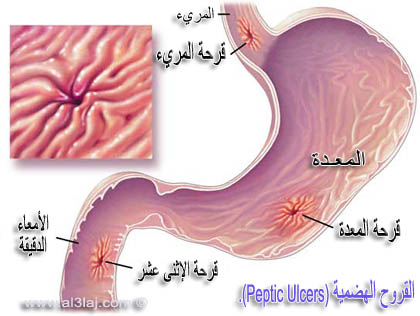 القروح الهضمية