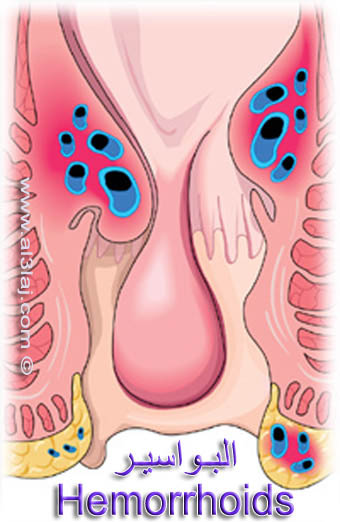 علاج البواسير