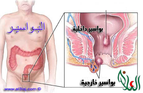 أنواع البواسير