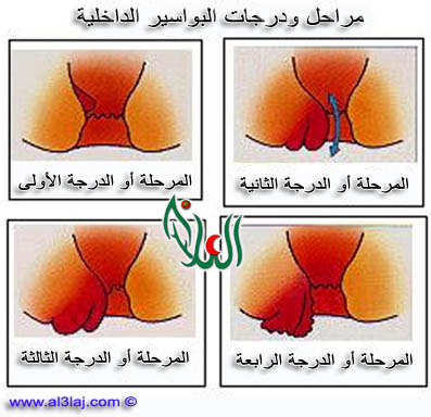 مراحل ودرجات البواسير الداخلية