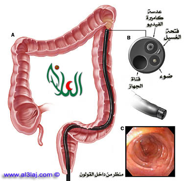 استخدام منظار القولون لاستبعاد أي أمراض عضوية أخرى