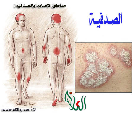 اجزاء الجسم التي تصاب بالصدفية