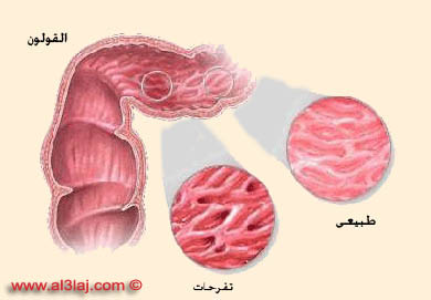 تتشابه أعراض أمراض الجهاز الهضمي مع بعضها